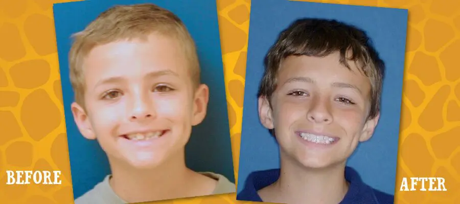 Before and After Orthodontic Photos - Jacaranda Smiles