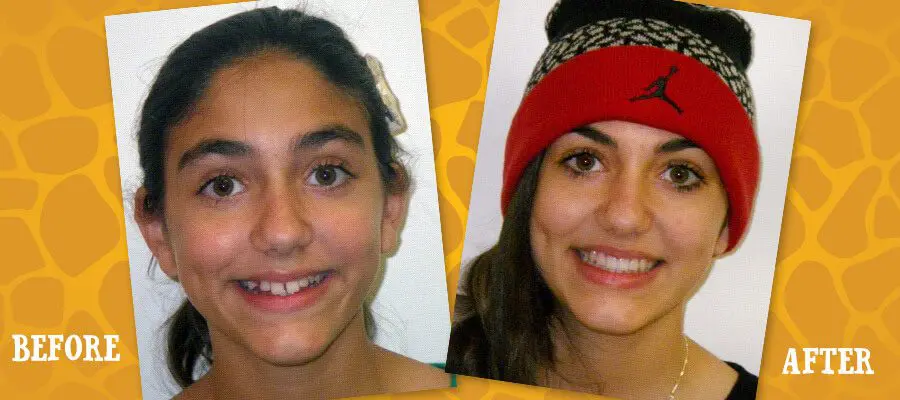 Before and After Orthodontic Photos - Jacaranda Smiles