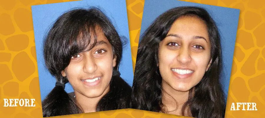 Before and After Orthodontic Photos - Jacaranda Smiles