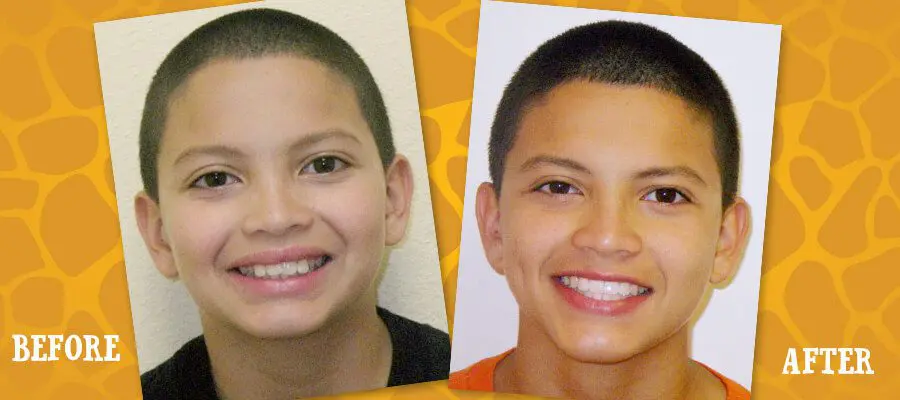 Before and After Orthodontic Photos - Jacaranda Smiles