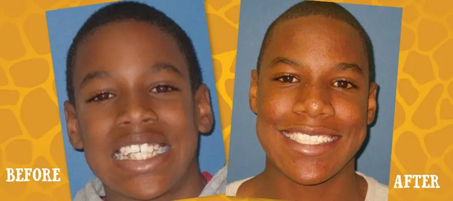 Before and After Orthodontic Photos - Jacaranda Smiles