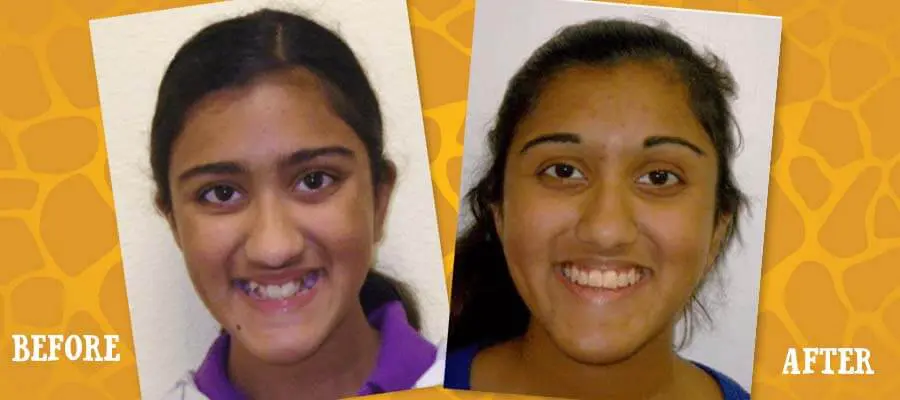 Before and After Orthodontic Photos - Jacaranda Smiles
