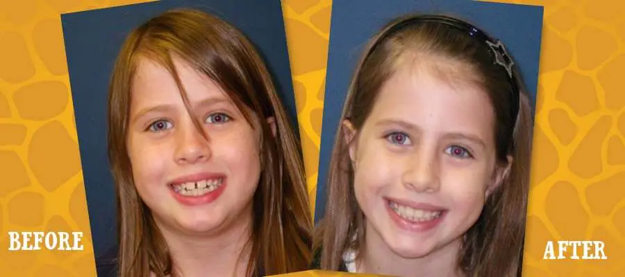 Before and After Orthodontic Photos - Jacaranda Smiles