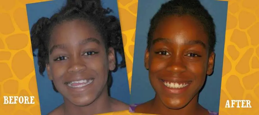 Before and After Orthodontic Photos - Jacaranda Smiles