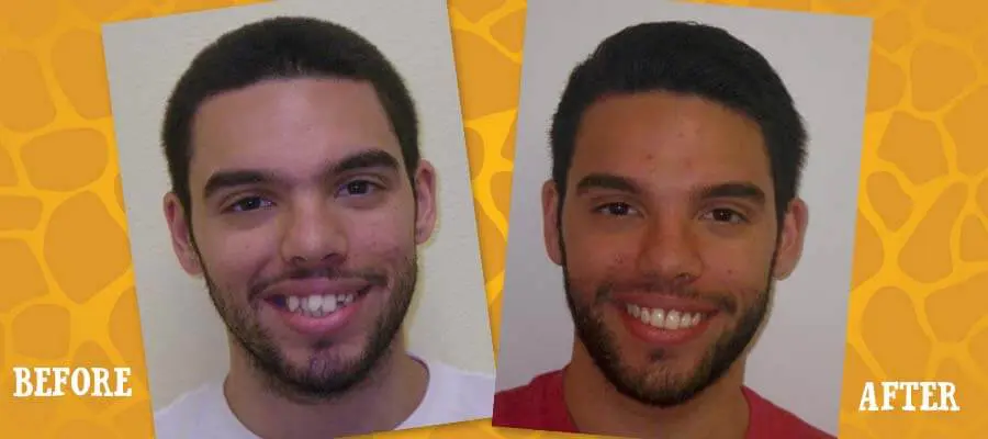 Before and After Orthodontic Photos - Jacaranda Smiles