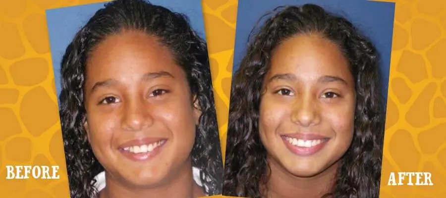 Before and After Orthodontic Photos - Jacaranda Smiles