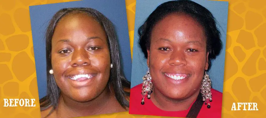 Before and After Orthodontic Photos - Jacaranda Smiles