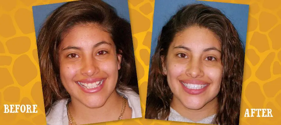 Before and After Orthodontic Photos - Jacaranda Smiles