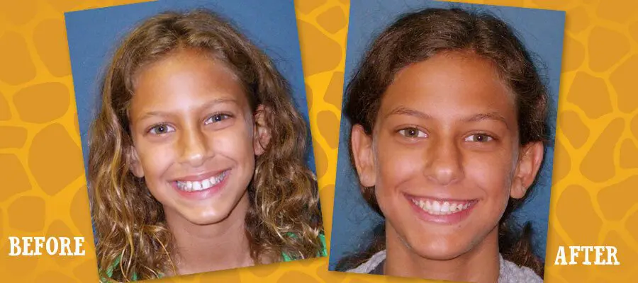 Before and After Orthodontic Photos - Jacaranda Smiles
