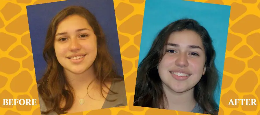 Before and After Orthodontic Photos - Jacaranda Smiles