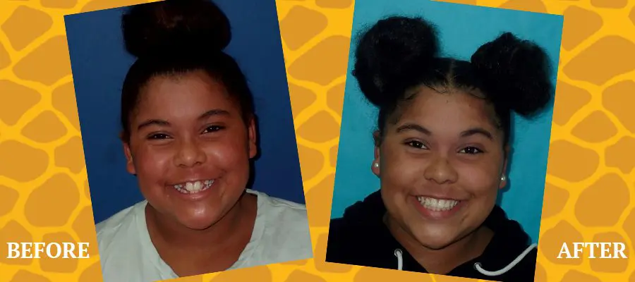 Before and After Orthodontic Photos - Jacaranda Smiles