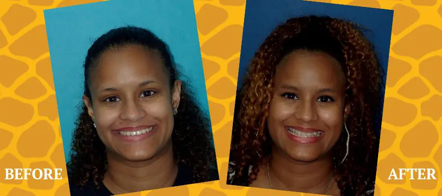 Before and After Orthodontic Photos - Jacaranda Smiles