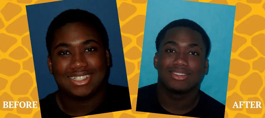 Before and After Orthodontic Photos - Jacaranda Smiles