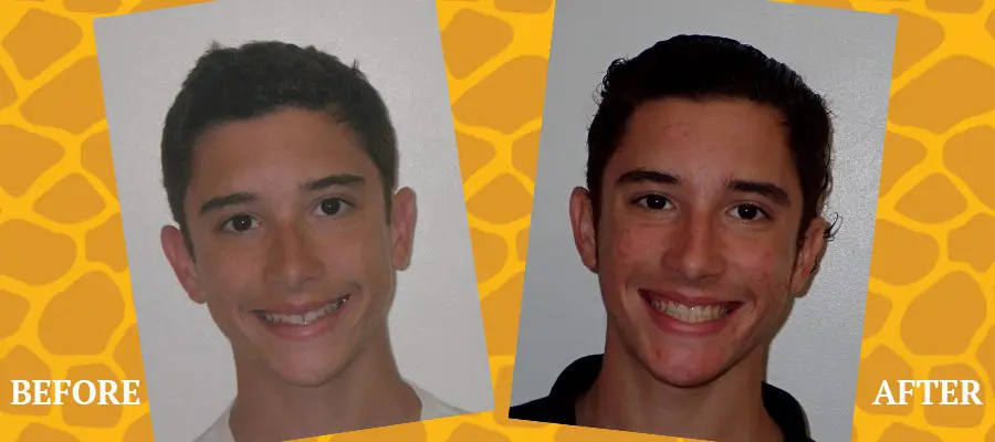 Before and After Orthodontic Photos - Jacaranda Smiles