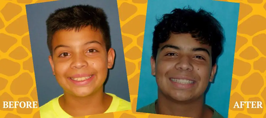 Before and After Orthodontic Photos - Jacaranda Smiles