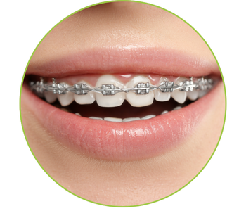 braces in plantation, fl