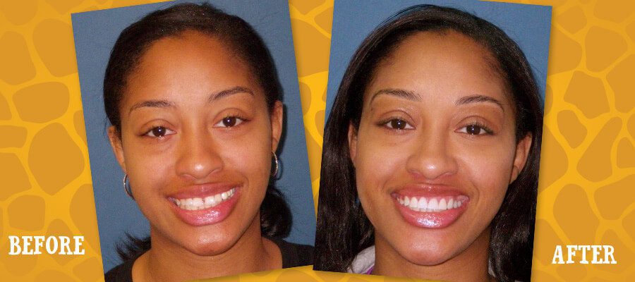 Before and After Orthodontic Photos - Jacaranda Smiles