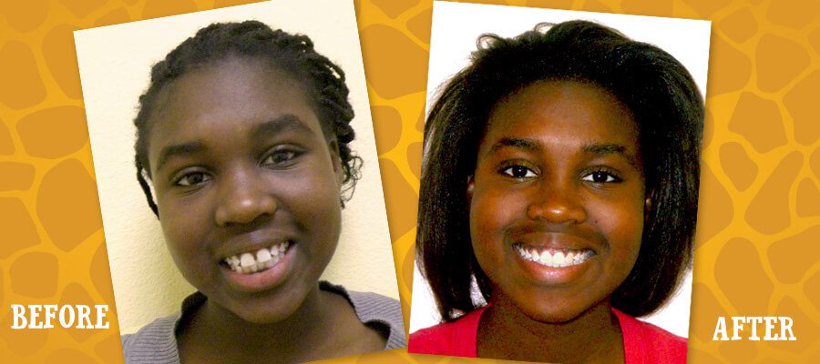 Before and After Orthodontic Photos - Jacaranda Smiles