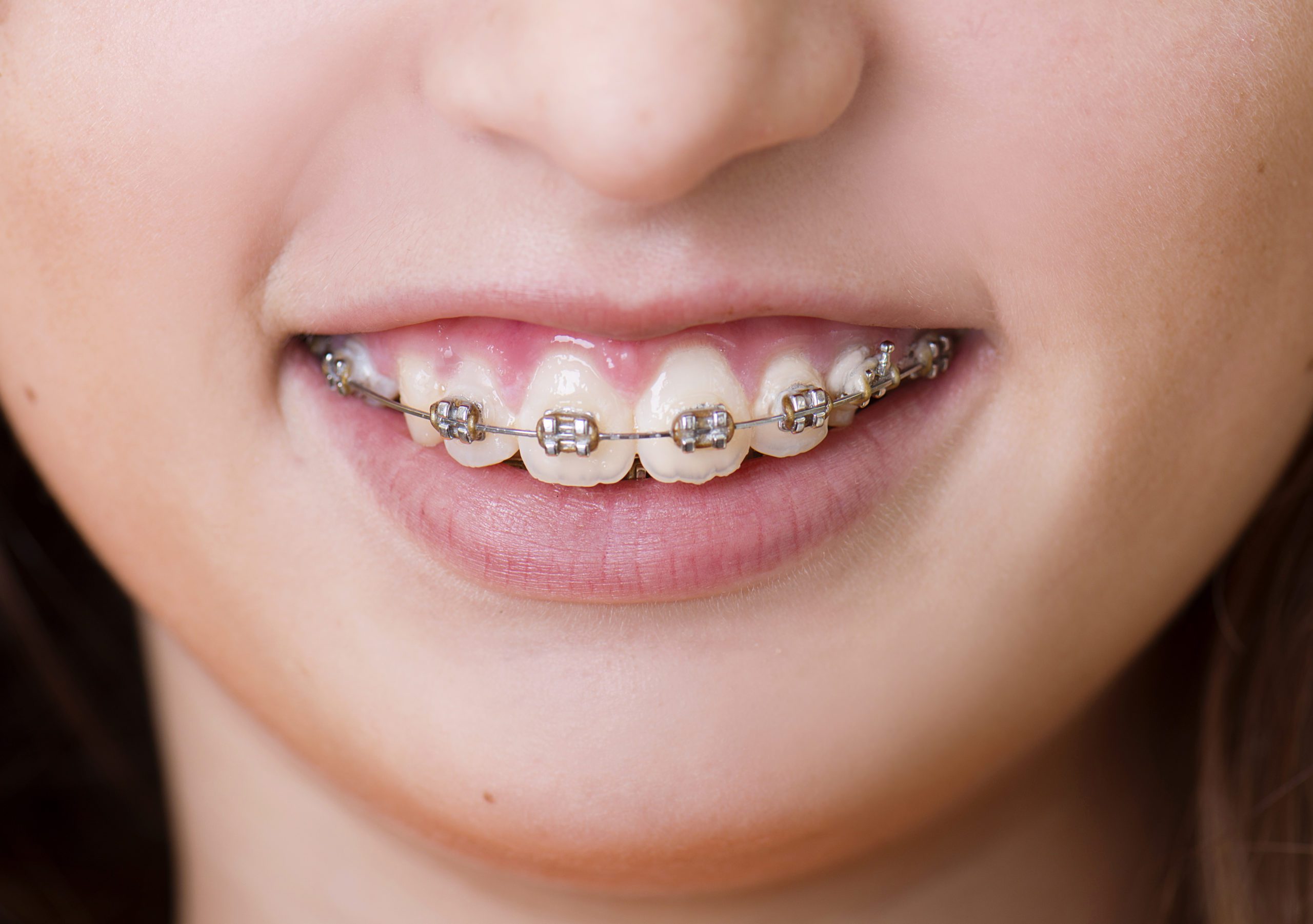 Talking With Your Child About Braces