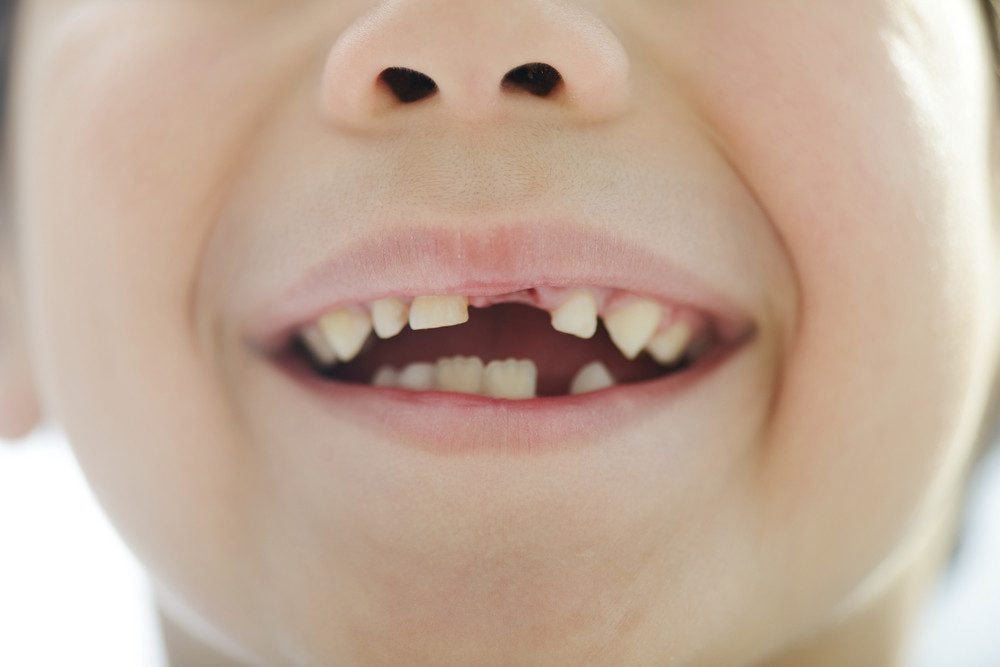 The Top 3 Reasons Why Your Child Needs a Space Maintainer